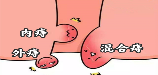 痔疮套扎吻合器怎么用【藤县人民医院健康小讲堂】普外二科：痔套扎术——痔患者的一个优选择_https://www.jmylbn.com_新闻资讯_第7张