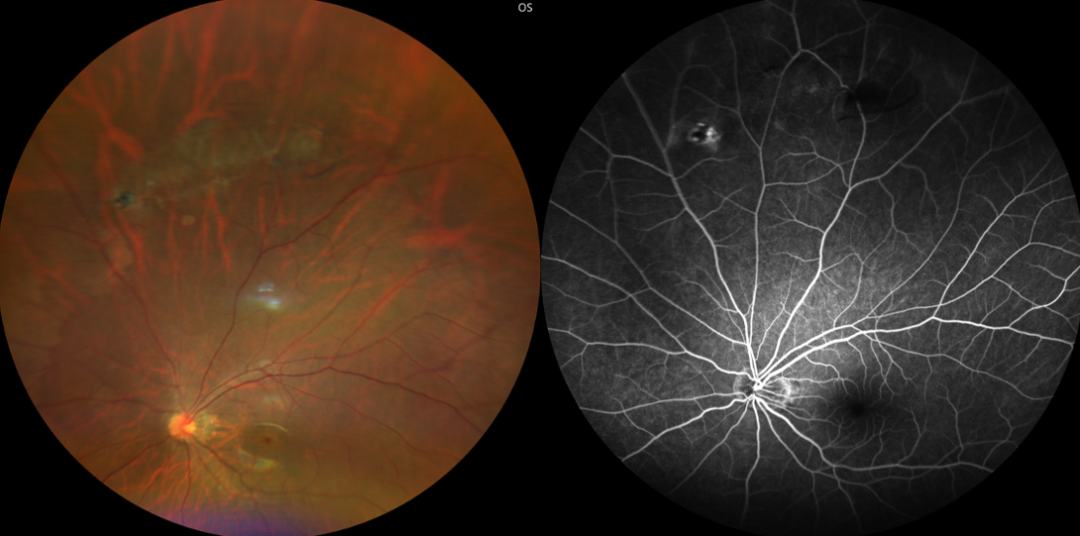 彩色眼底照相查什么儿医小课堂 595 ｜ 眼底健康侦察兵：让隐匿疾病无处遁形_https://www.jmylbn.com_新闻资讯_第3张