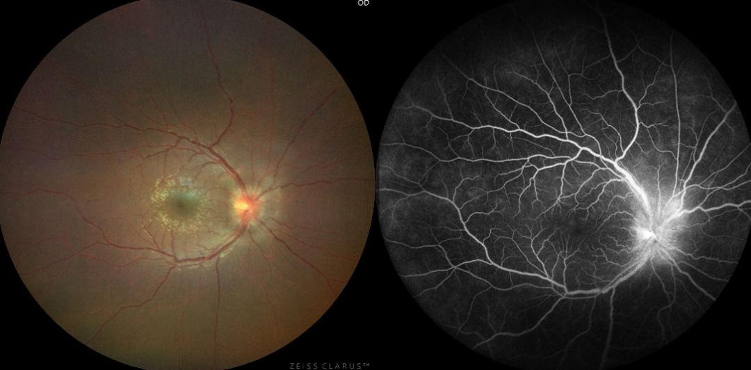 彩色眼底照相查什么儿医小课堂 595 ｜ 眼底健康侦察兵：让隐匿疾病无处遁形_https://www.jmylbn.com_新闻资讯_第4张