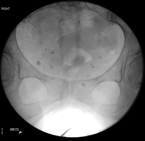 什么是c型臂术中透视骨科精读 ｜ 股骨近端骨折的转子区域与矢状面力线术中透视技巧_https://www.jmylbn.com_新闻资讯_第4张