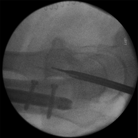 什么是c型臂术中透视骨科精读 ｜ 股骨近端骨折的转子区域与矢状面力线术中透视技巧_https://www.jmylbn.com_新闻资讯_第14张