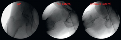 什么是c型臂术中透视骨科精读 ｜ 股骨近端骨折的转子区域与矢状面力线术中透视技巧_https://www.jmylbn.com_新闻资讯_第8张