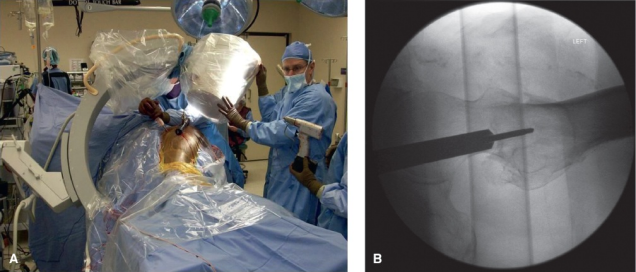 什么是c型臂术中透视骨科精读 ｜ 股骨近端骨折的转子区域与矢状面力线术中透视技巧_https://www.jmylbn.com_新闻资讯_第26张