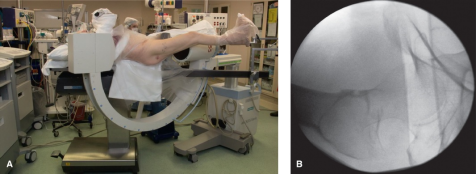 什么是c型臂术中透视骨科精读 ｜ 股骨近端骨折的转子区域与矢状面力线术中透视技巧_https://www.jmylbn.com_新闻资讯_第6张
