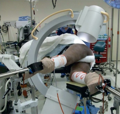 什么是c型臂术中透视骨科精读 ｜ 股骨近端骨折的转子区域与矢状面力线术中透视技巧_https://www.jmylbn.com_新闻资讯_第24张