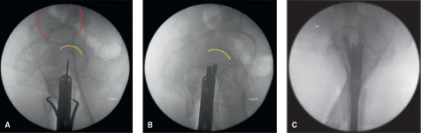 什么是c型臂术中透视骨科精读 ｜ 股骨近端骨折的转子区域与矢状面力线术中透视技巧_https://www.jmylbn.com_新闻资讯_第23张