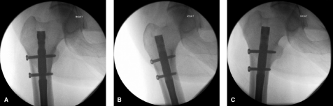 什么是c型臂术中透视骨科精读 ｜ 股骨近端骨折的转子区域与矢状面力线术中透视技巧_https://www.jmylbn.com_新闻资讯_第12张