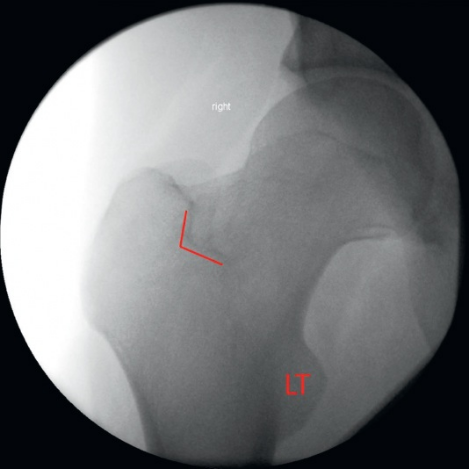 什么是c型臂术中透视骨科精读 ｜ 股骨近端骨折的转子区域与矢状面力线术中透视技巧_https://www.jmylbn.com_新闻资讯_第5张