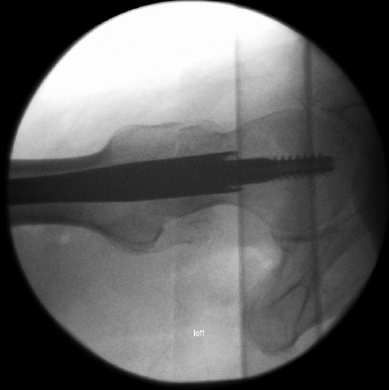 什么是c型臂术中透视骨科精读 ｜ 股骨近端骨折的转子区域与矢状面力线术中透视技巧_https://www.jmylbn.com_新闻资讯_第28张
