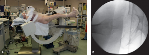 什么是c型臂术中透视骨科精读 ｜ 股骨近端骨折的转子区域与矢状面力线术中透视技巧_https://www.jmylbn.com_新闻资讯_第7张