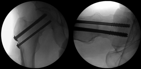 什么是c型臂术中透视骨科精读 ｜ 股骨近端骨折的转子区域与矢状面力线术中透视技巧_https://www.jmylbn.com_新闻资讯_第9张
