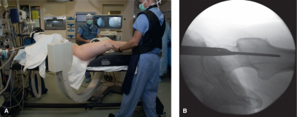 什么是c型臂术中透视骨科精读 ｜ 股骨近端骨折的转子区域与矢状面力线术中透视技巧_https://www.jmylbn.com_新闻资讯_第16张