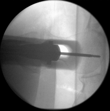 什么是c型臂术中透视骨科精读 ｜ 股骨近端骨折的转子区域与矢状面力线术中透视技巧_https://www.jmylbn.com_新闻资讯_第27张