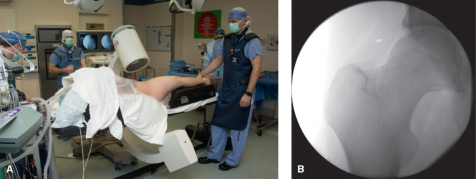 什么是c型臂术中透视骨科精读 ｜ 股骨近端骨折的转子区域与矢状面力线术中透视技巧_https://www.jmylbn.com_新闻资讯_第11张