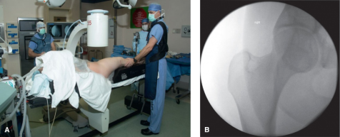 什么是c型臂术中透视骨科精读 ｜ 股骨近端骨折的转子区域与矢状面力线术中透视技巧_https://www.jmylbn.com_新闻资讯_第10张
