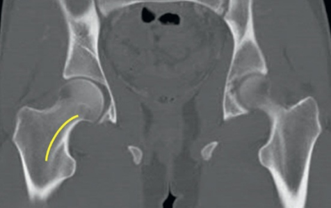 什么是c型臂术中透视骨科精读 ｜ 股骨近端骨折的转子区域与矢状面力线术中透视技巧_https://www.jmylbn.com_新闻资讯_第1张
