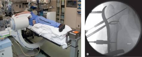 什么是c型臂术中透视骨科精读 ｜ 股骨近端骨折的转子区域与矢状面力线术中透视技巧_https://www.jmylbn.com_新闻资讯_第20张