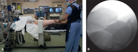 什么是c型臂术中透视骨科精读 ｜ 股骨近端骨折的转子区域与矢状面力线术中透视技巧_https://www.jmylbn.com_新闻资讯_第15张