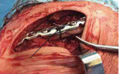 缝伤口怎么打结骨科打结的常用手法大全，你了解多少？_https://www.jmylbn.com_新闻资讯_第17张