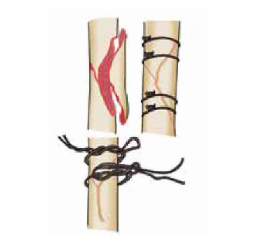 缝伤口怎么打结骨科打结的常用手法大全，你了解多少？_https://www.jmylbn.com_新闻资讯_第21张