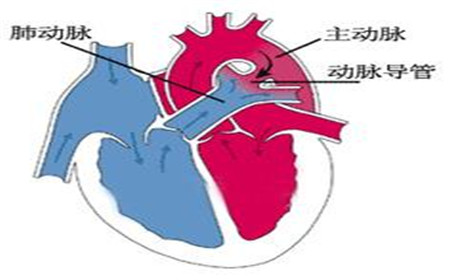 【妇儿科普】小管道也有大影响，不要让小疾病造成大伤害动脉导管未闭