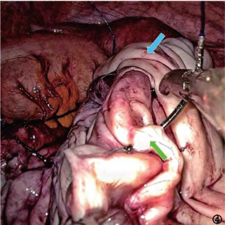 缝合时怎么持钳打结笨手笨脚？妇科腹腔镜不同部位的缝合技巧，多图+视频教学，包教包会→_https://www.jmylbn.com_新闻资讯_第6张