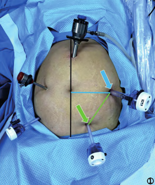 缝合时怎么持钳打结笨手笨脚？妇科腹腔镜不同部位的缝合技巧，多图+视频教学，包教包会→_https://www.jmylbn.com_新闻资讯_第2张