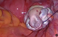 缝合时怎么持钳打结笨手笨脚？妇科腹腔镜不同部位的缝合技巧，多图+视频教学，包教包会→_https://www.jmylbn.com_新闻资讯_第7张