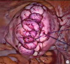 缝合时怎么持钳打结笨手笨脚？妇科腹腔镜不同部位的缝合技巧，多图+视频教学，包教包会→_https://www.jmylbn.com_新闻资讯_第8张