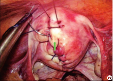 缝合时怎么持钳打结笨手笨脚？妇科腹腔镜不同部位的缝合技巧，多图+视频教学，包教包会→_https://www.jmylbn.com_新闻资讯_第9张