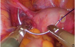 缝合时怎么持钳打结笨手笨脚？妇科腹腔镜不同部位的缝合技巧，多图+视频教学，包教包会→_https://www.jmylbn.com_新闻资讯_第3张