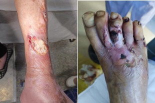 为什么糖尿病不能震动【新项目】糖尿病患者的福音—内分泌风湿免疫组数字震动感觉阈值检测仪来啦！_https://www.jmylbn.com_新闻资讯_第14张