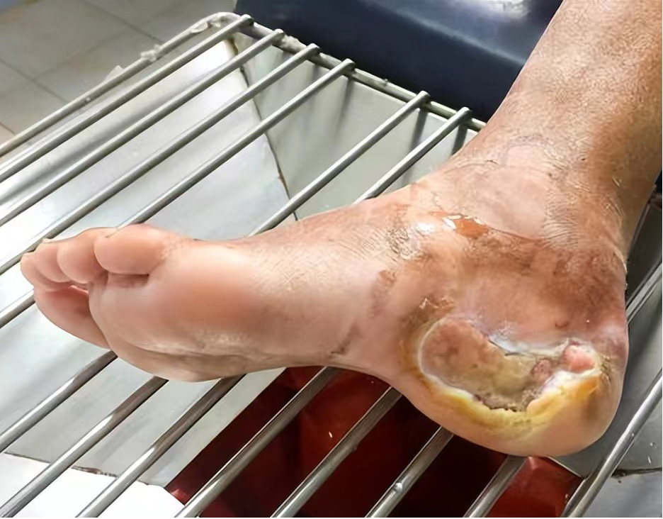 为什么糖尿病不能震动【新项目】糖尿病患者的福音—内分泌风湿免疫组数字震动感觉阈值检测仪来啦！_https://www.jmylbn.com_新闻资讯_第15张