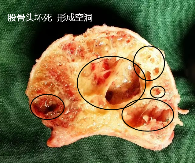 那些说骨坏死积液水肿问题不大的人都是刽子手
