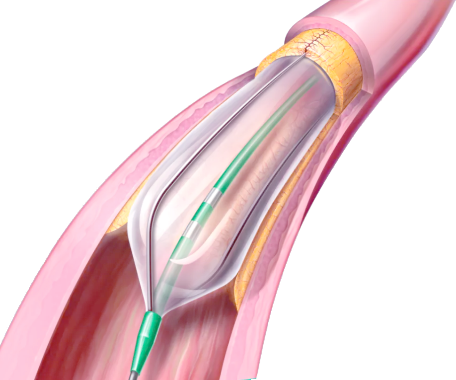pta在医学上什么意思科室协作新典范  打通患者“生命线”——我院肾内科成功开展首例DSA引导下动静脉内瘘球囊扩张术_https://www.jmylbn.com_新闻资讯_第3张