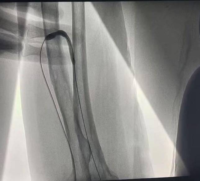 pta在医学上什么意思科室协作新典范  打通患者“生命线”——我院肾内科成功开展首例DSA引导下动静脉内瘘球囊扩张术_https://www.jmylbn.com_新闻资讯_第6张