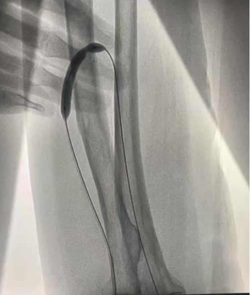 pta在医学上什么意思科室协作新典范  打通患者“生命线”——我院肾内科成功开展首例DSA引导下动静脉内瘘球囊扩张术_https://www.jmylbn.com_新闻资讯_第5张