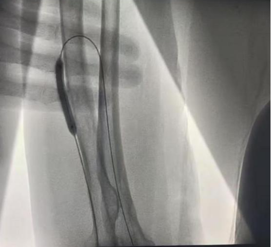 pta在医学上什么意思科室协作新典范  打通患者“生命线”——我院肾内科成功开展首例DSA引导下动静脉内瘘球囊扩张术_https://www.jmylbn.com_新闻资讯_第7张