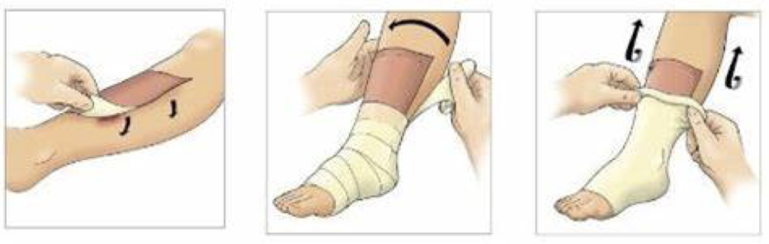 人工敷料怎么照顾伤口【伤口造口】二层敷料的选择和使用_https://www.jmylbn.com_新闻资讯_第2张