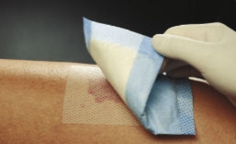 人工敷料怎么照顾伤口【伤口造口】二层敷料的选择和使用_https://www.jmylbn.com_新闻资讯_第1张