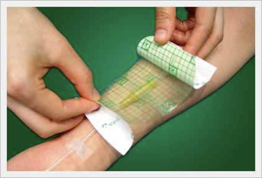 人工敷料怎么照顾伤口【伤口造口】二层敷料的选择和使用_https://www.jmylbn.com_新闻资讯_第6张