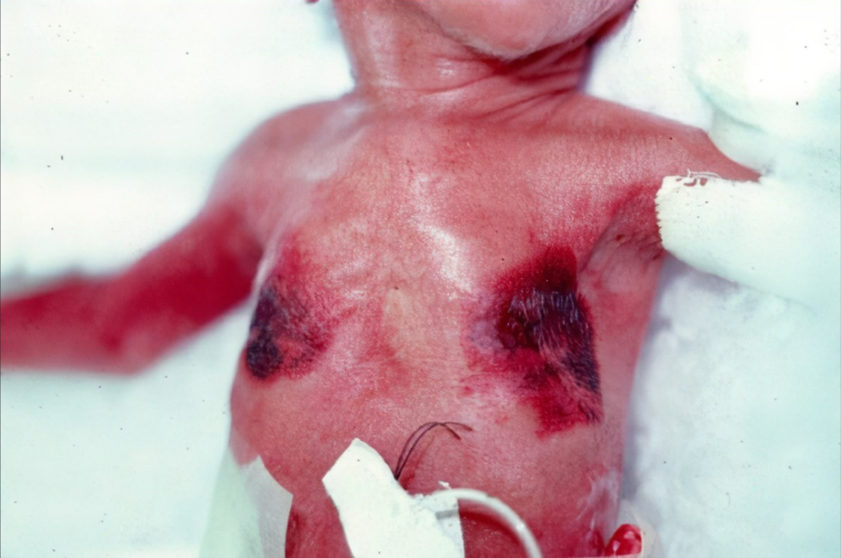 皮肤粘合剂怎么去掉早产儿医用粘合剂相关皮肤损伤和化学损伤案例_https://www.jmylbn.com_新闻资讯_第1张