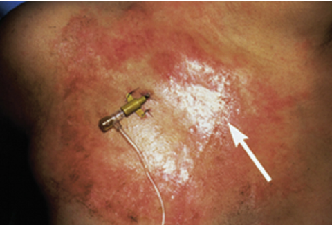 皮肤粘合剂怎么去掉早产儿医用粘合剂相关皮肤损伤和化学损伤案例_https://www.jmylbn.com_新闻资讯_第2张