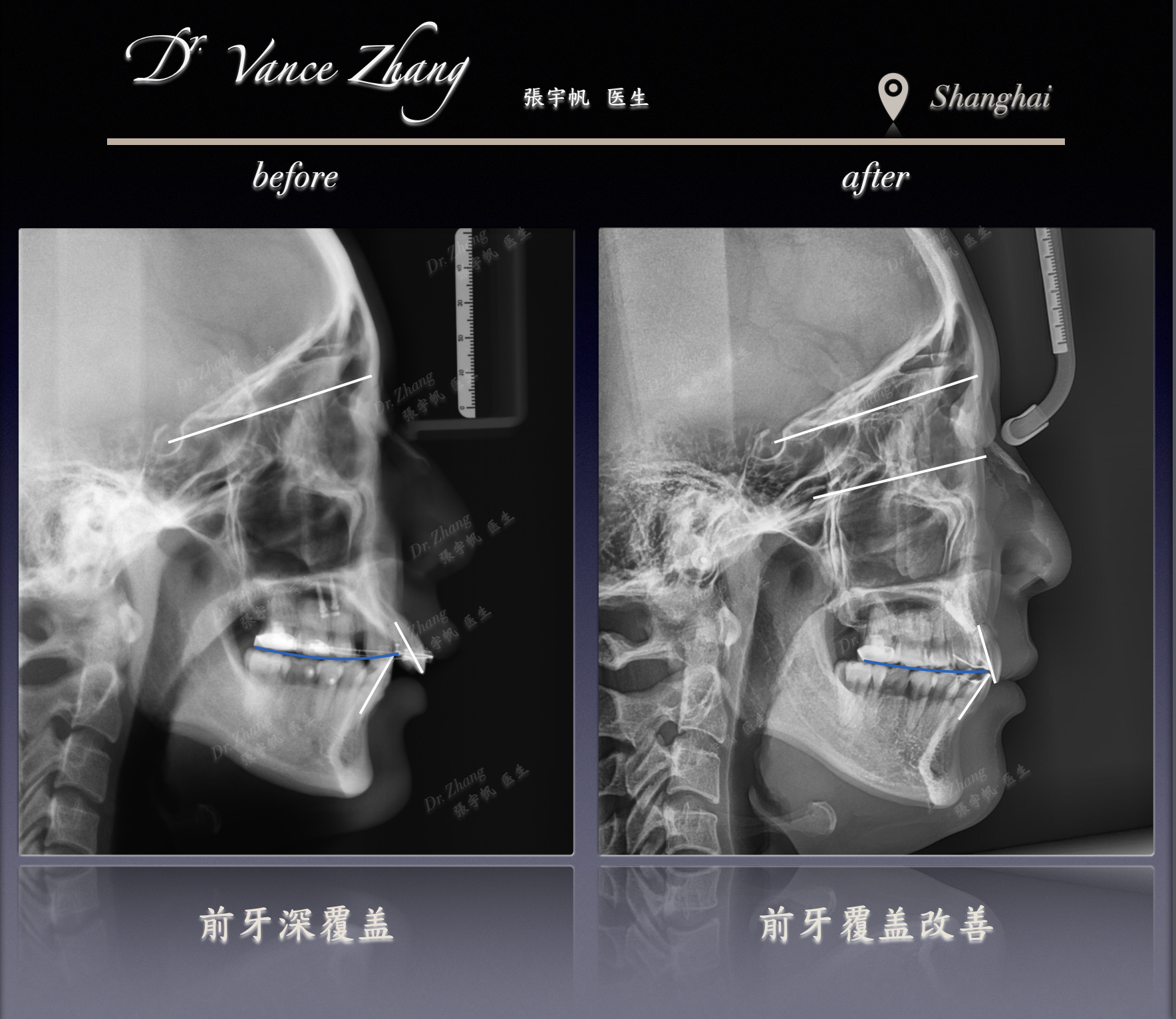 极重度牙根吸收的正畸治疗正式病例贴图15