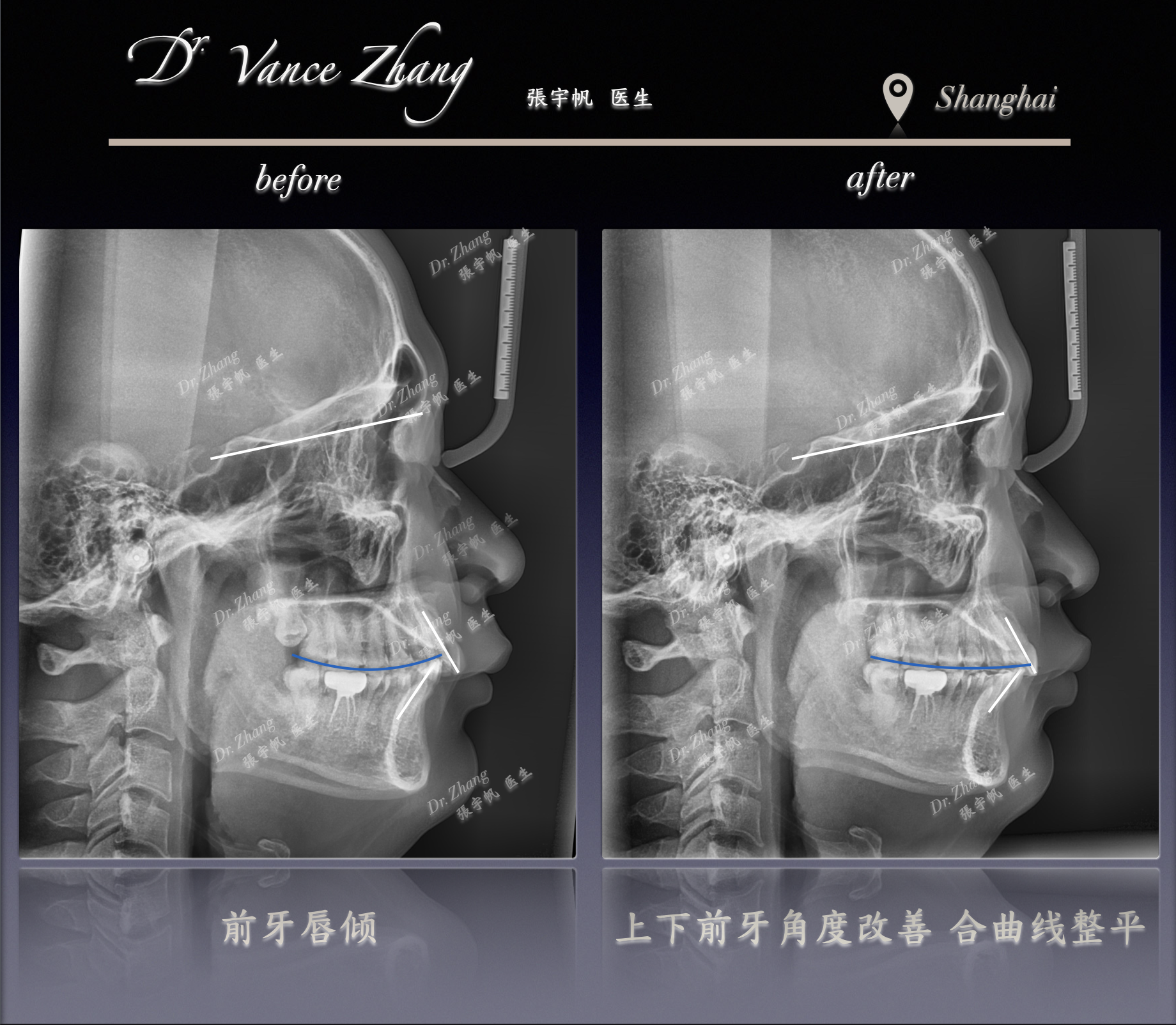 Ⅱ类错𬌗的支抗钉辅助磨牙远移正式病例贴图15