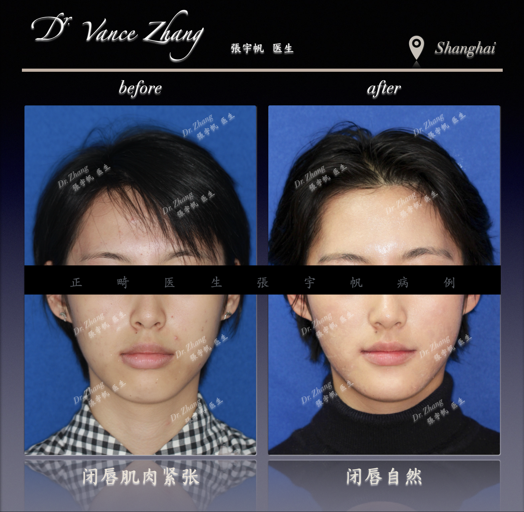 牙齿前突改善：美观与安全的平衡正式病例贴图2