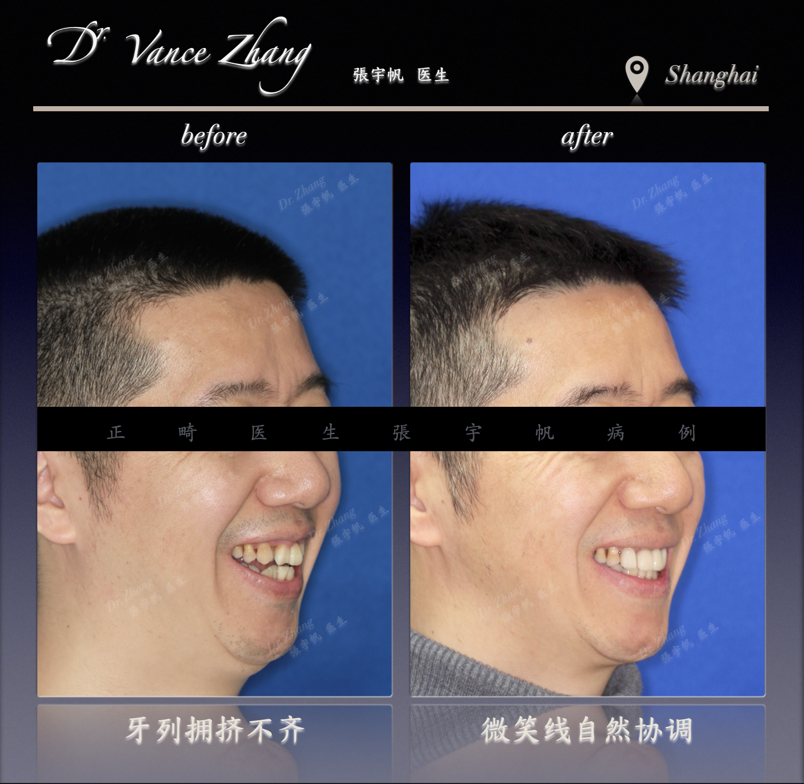 拔除下7后近移智齿替代正式病例贴图4