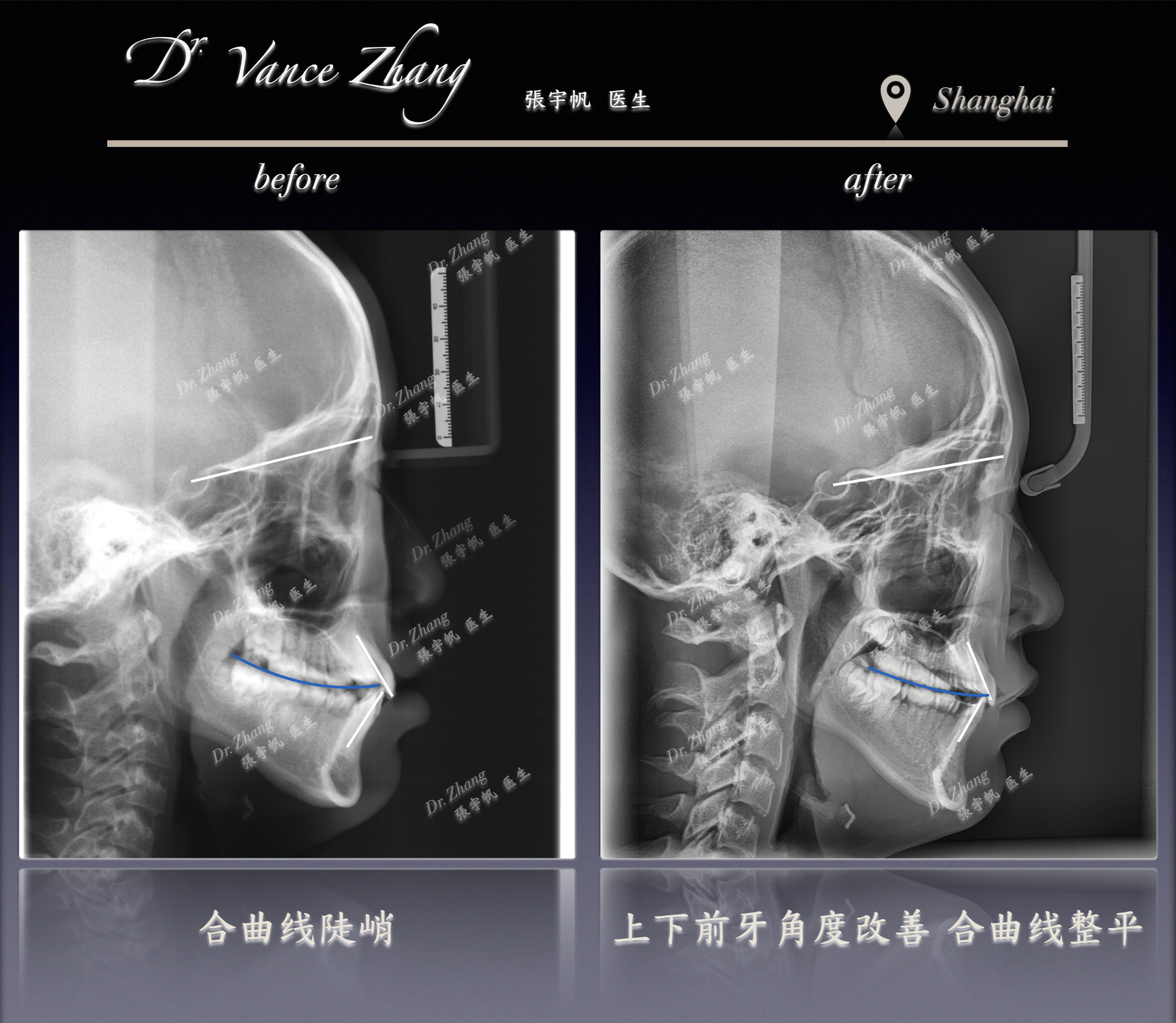 从牙列杂乱到笑容舒展正式病例贴图15