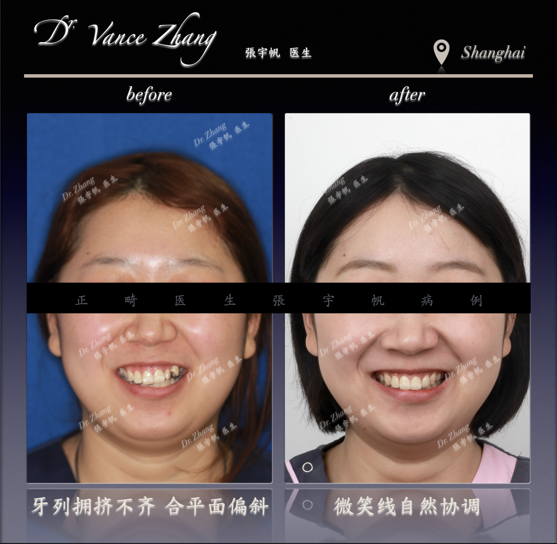 咬合平面偏斜与露龈笑改善正式病例贴图3