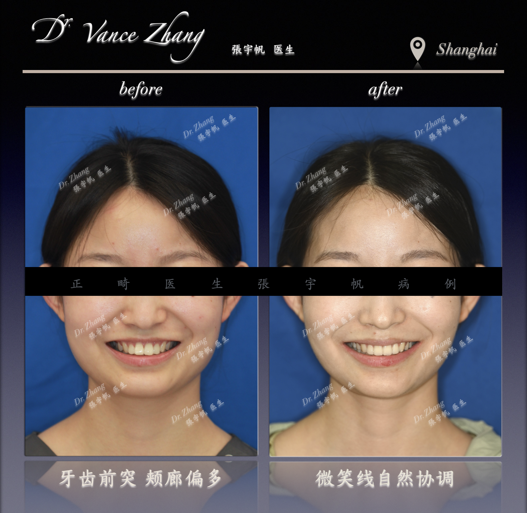 不拔牙之外的另一种选择正式病例贴图3